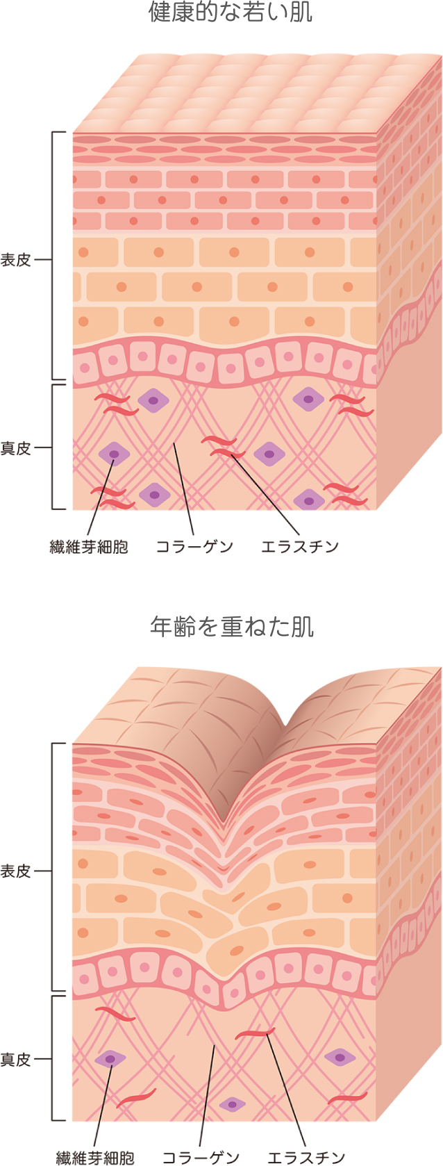 紫外線もお肌の老化を招く原因です。紫外線はコラーゲンを破壊するため、加齢と同じようにシワやたるみを引き起こします。